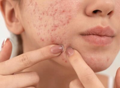 Concerns acne