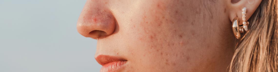 Concerns acne scarring