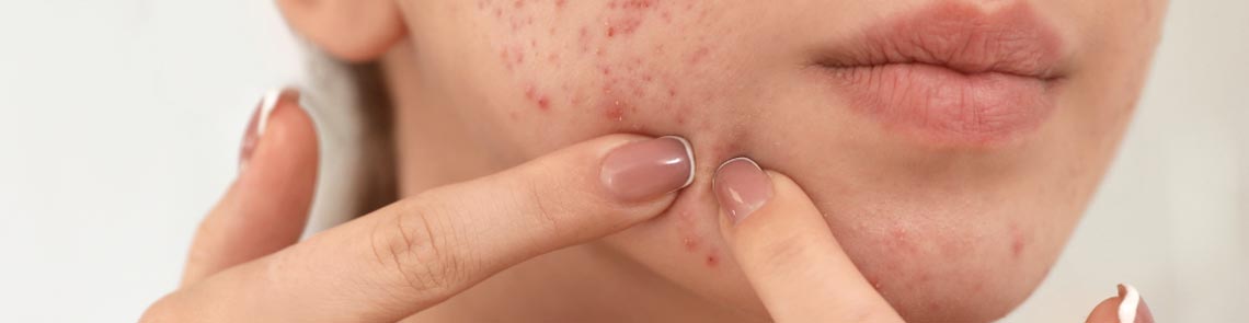 Concerns acne