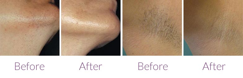 Laser Hair Removal Results