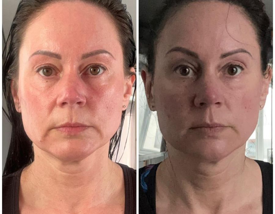 Radio Frequency before and after